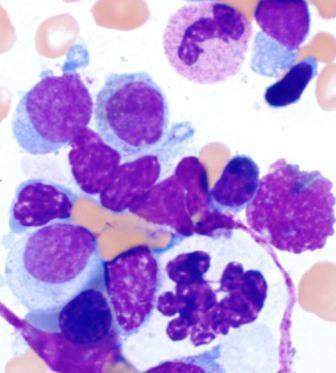 Bone marrow aspirate: dysgranulopoiesis